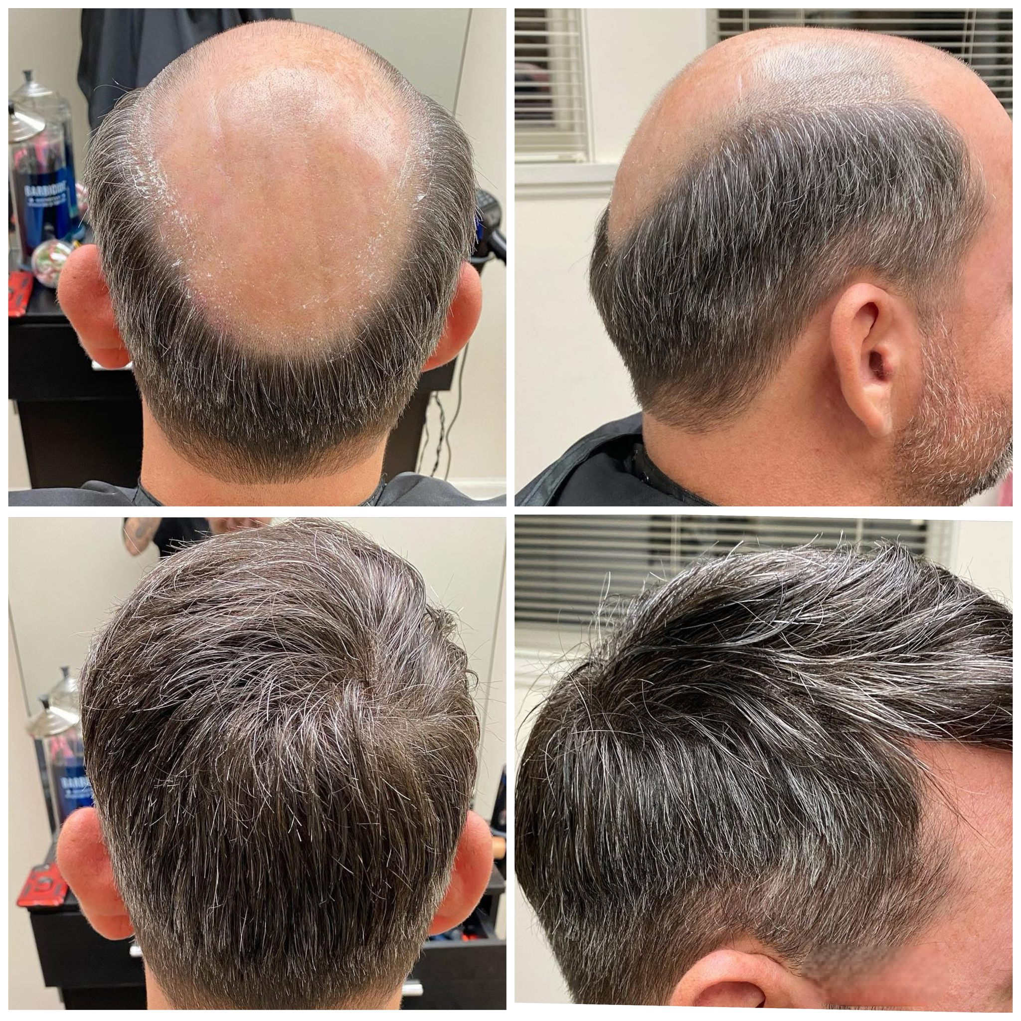 Hair Restoration